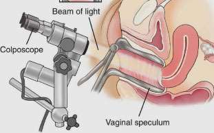 Colposcopy