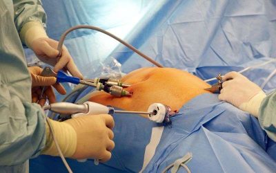 laparoscopic hysterectomy surgery